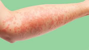Detailed view of eczema on the skin, showing red, inflamed patches. Eczema dermatologist Dubai