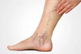 Varicose veins in legs showing swollen and distorted blood vessels related to varco veins.