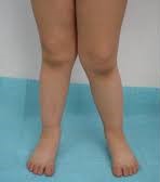 Image depicting a patient with genu valgum knock knee, highlighting the expertise of an ortho specialist in Dubai.