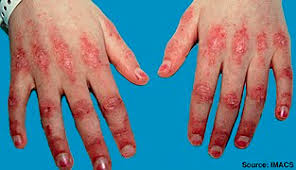 Dermatomyositis symptoms, rash, and polymyositis dermatomyositis explained