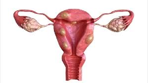 Illustration of uterine fibroid showing fibroids in womb, fibromyoma of uterus, fibroids inside uterus, and effective fibroids treatment options.
