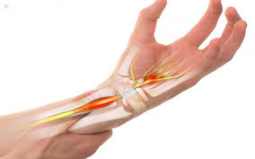 Tendinitis Treatment in Dubai